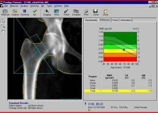 How to Read Bone Density Results 1