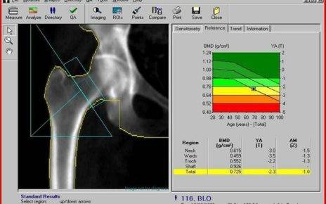 How to Read Bone Density Results 1