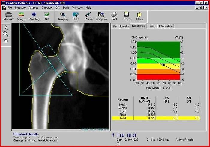 How to Read Bone Density Results 3