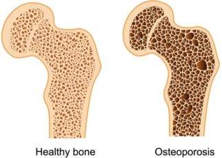 What is Bone Density 1