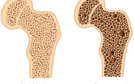 What is Bone Density 1