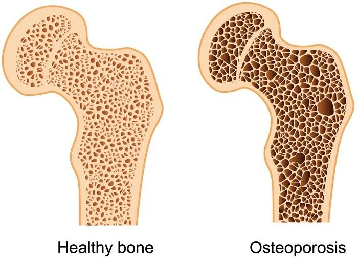 What is Bone Density 4