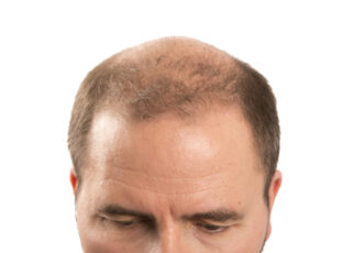 Major Causes Of Hair Loss