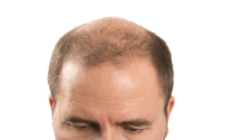 Major Causes Of Hair Loss