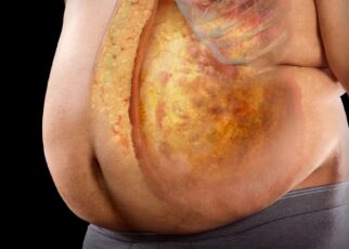 What Are The Warning Signs Of Obesity