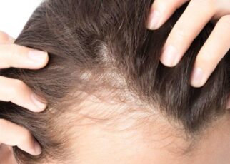 Lack Of These Elements In Your Body Can Result In Baldness