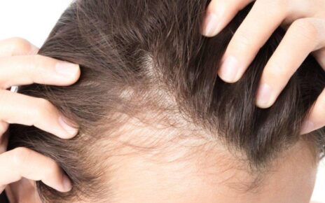 Lack Of These Elements In Your Body Can Result In Baldness