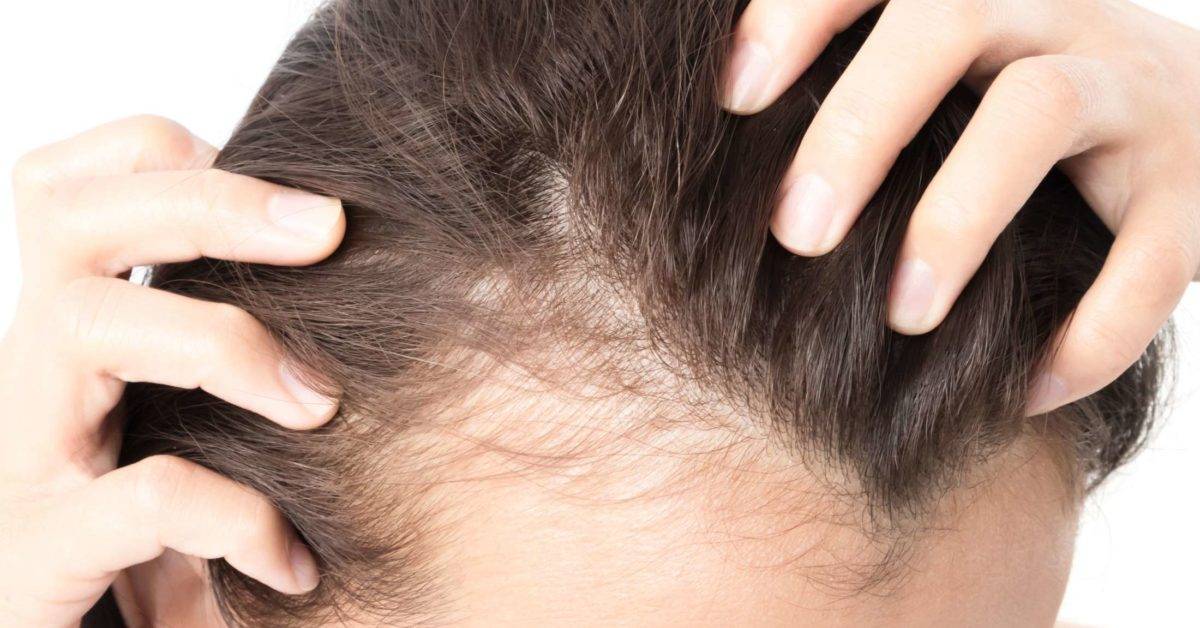 Lack Of These Elements In Your Body Can Result In Baldness