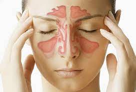 Sinus Infection: Symptoms, Causes, and Treatment