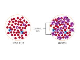 Blood Cancer: Symptoms and treatment options