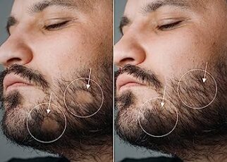 minoxidil for beard