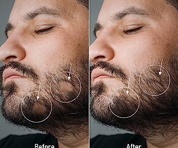 minoxidil for beard