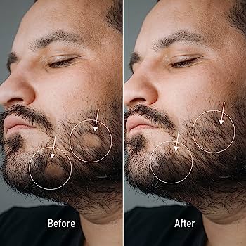 minoxidil for beard