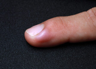 ingrown fingernail