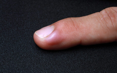 ingrown fingernail